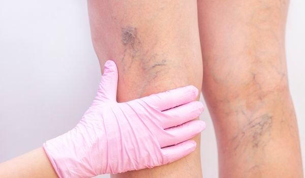 Tê Bì & Suy Giãn Tĩnh Mạch