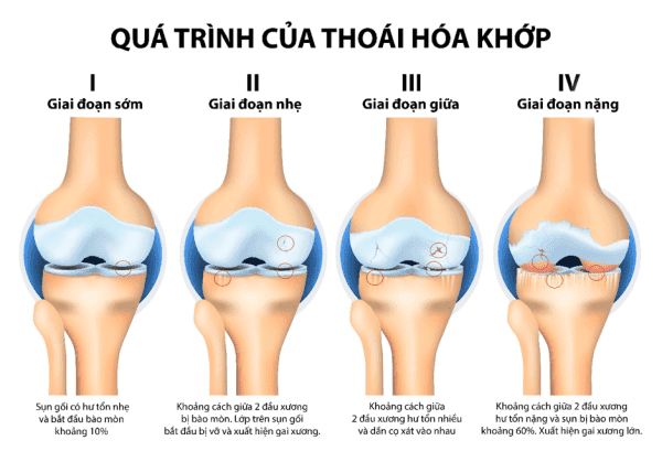 cac giai doan viem khop goi