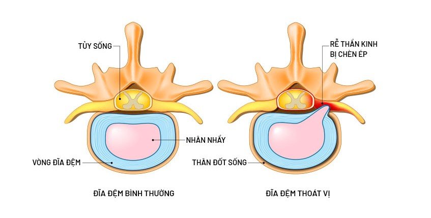 tinh trang dia dem bi thoat vi