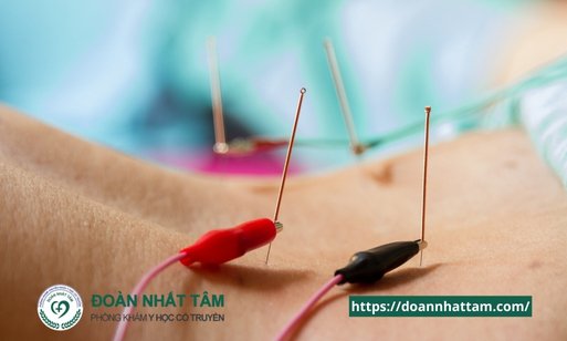 10 Lợi Ích Thần Kỳ Của Châm Cứu Mà Bạn Chưa Từng Nghe Đến (2)