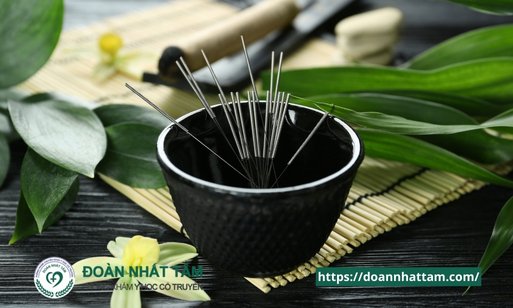 10 Lợi Ích Thần Kỳ Của Châm Cứu Mà Bạn Chưa Từng Nghe Đến (3)