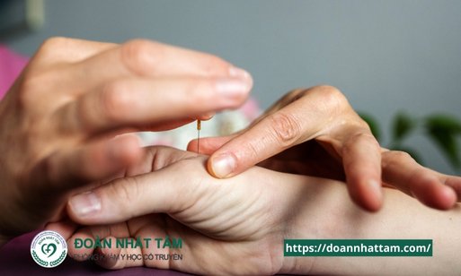 10 Lợi Ích Thần Kỳ Của Châm Cứu Mà Bạn Chưa Từng Nghe Đến