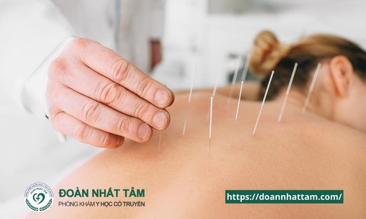 Châm Cứu Có Thật Sự Hiệu Quả Giải Mã Bí Ẩn Về Kim Châm Trị Liệu (2) Châm Cứu Có Thật Sự Hiệu Quả Giải Mã Bí Ẩn Về Kim Châm Trị Liệu (2)
