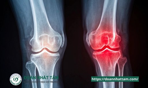 Cứng Khớp Gối Dấu Hiệu Cảnh Báo và Phương Pháp Khắc Phục Tối Ưu