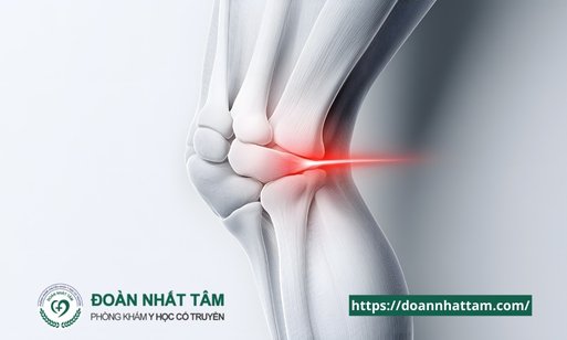 Đau Khớp Gối Nguyên Nhân, Triệu Chứng và Cách Điều Trị Hiệu Quả (2) Đau Khớp Gối Nguyên Nhân, Triệu Chứng và Cách Điều Trị Hiệu Quả (2)