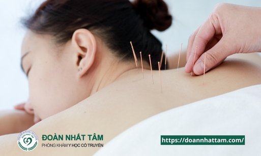 Sự Thật Bất Ngờ Về Châm Cứu Không Chỉ Giảm Đau Mà Còn Chữa Bách Bệnh!