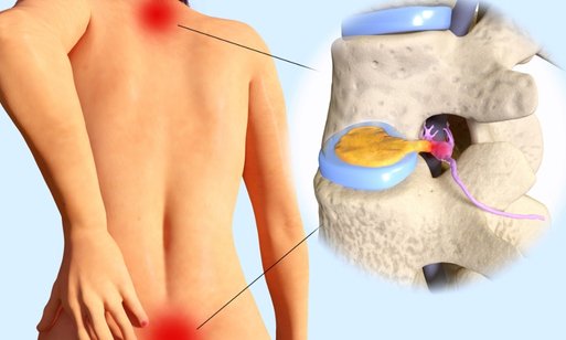 THOÁT VỊ ĐĨA ĐỆM 4 phòng khám y học cổ truyền đoàn nhất tâm